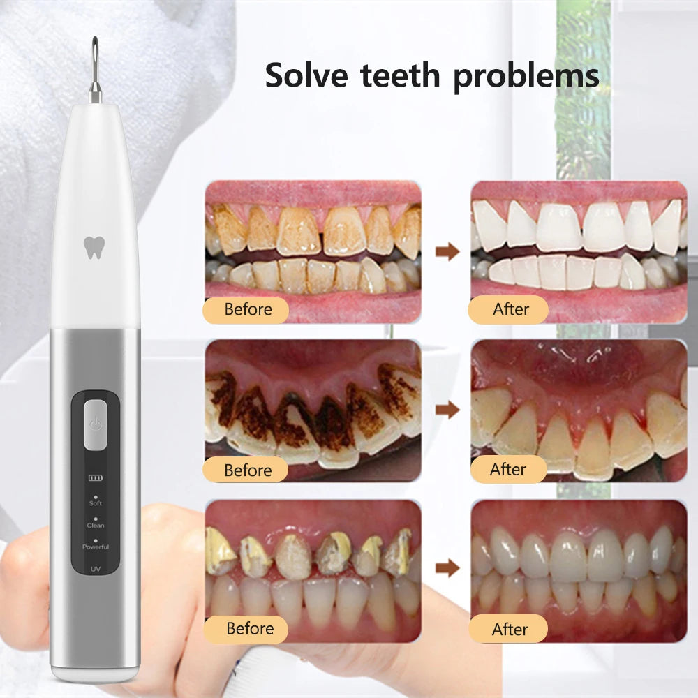 thumbnail image 2 of Ultrasonic Tooth Cleaner – Electric Plaque And Dental Calculus Remover, Adjustable 2 of 5