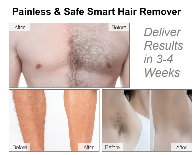 Smart Hair Remover - iSmart Home Gadgets Limited